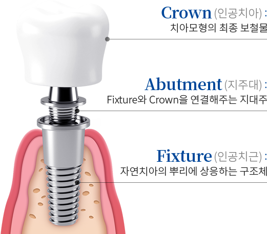 임플란트 구성