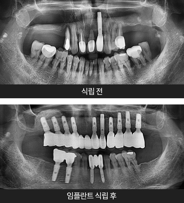 임플란트사례1