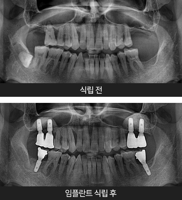임플란트사례3