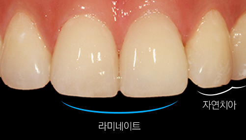 5일완성 라미네이트