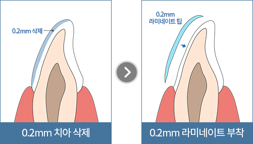최소의 두께 라미네이트