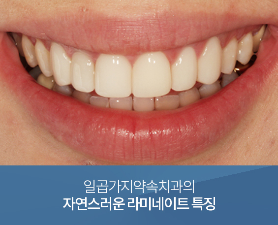 자연스러운 라미네이트