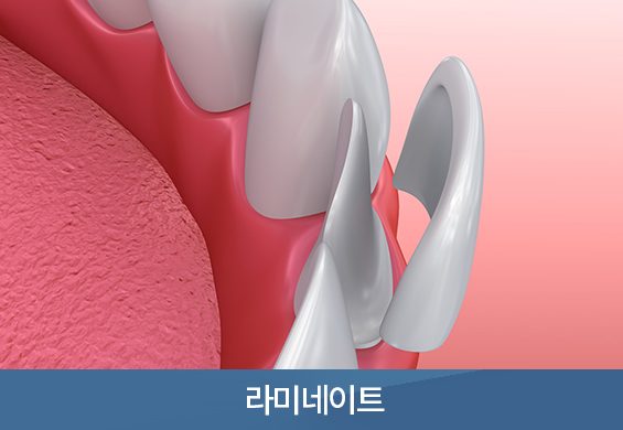 라미네이트 특징