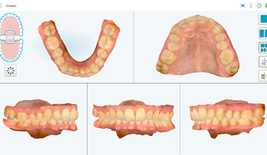iTero 3D 구강스캔 화면