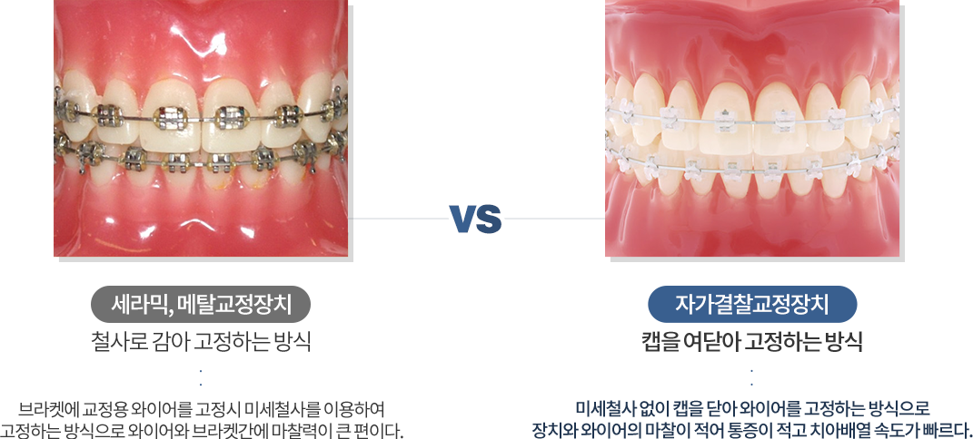 자가결찰교정치와 세라믹,메탈교정장치의 비교