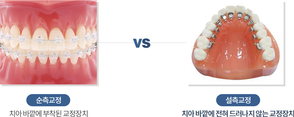 설측교정과 순측교정 비교