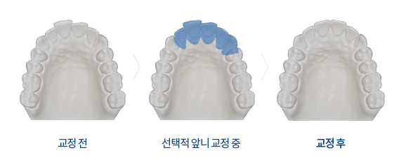 원하는 치아만 빠르게 교정