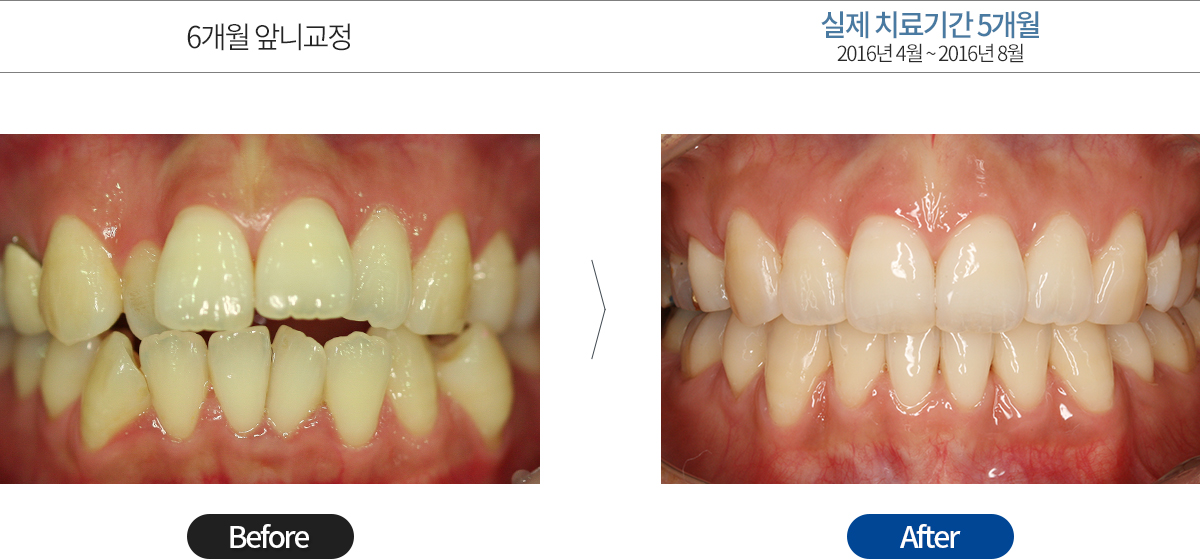 앞니교정치료과정사진