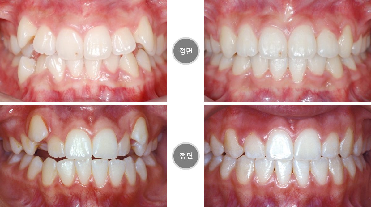 덧니교정전후사진