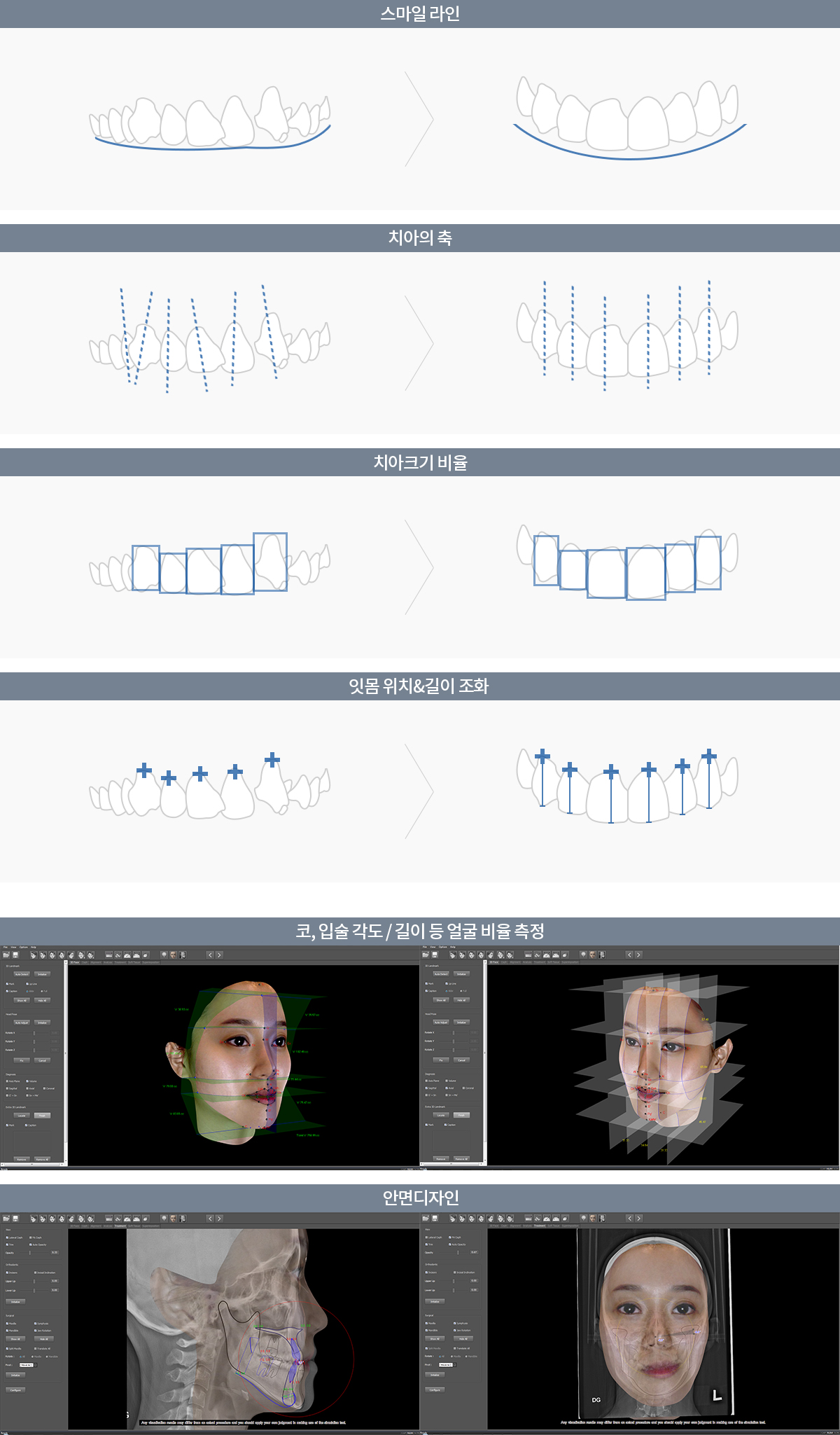 덧니교정키포인트