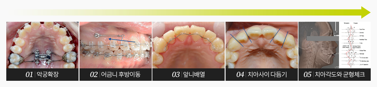 덧니교정과정