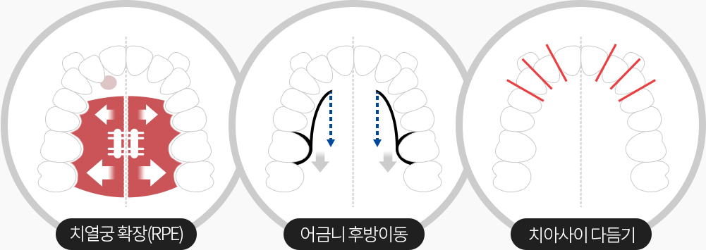 덧니교정공간형성과정
