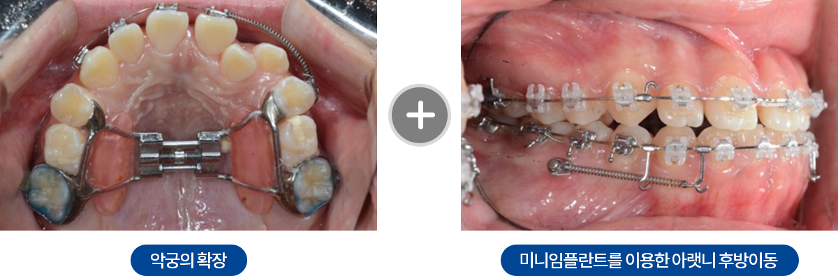 주걱턱치료방법