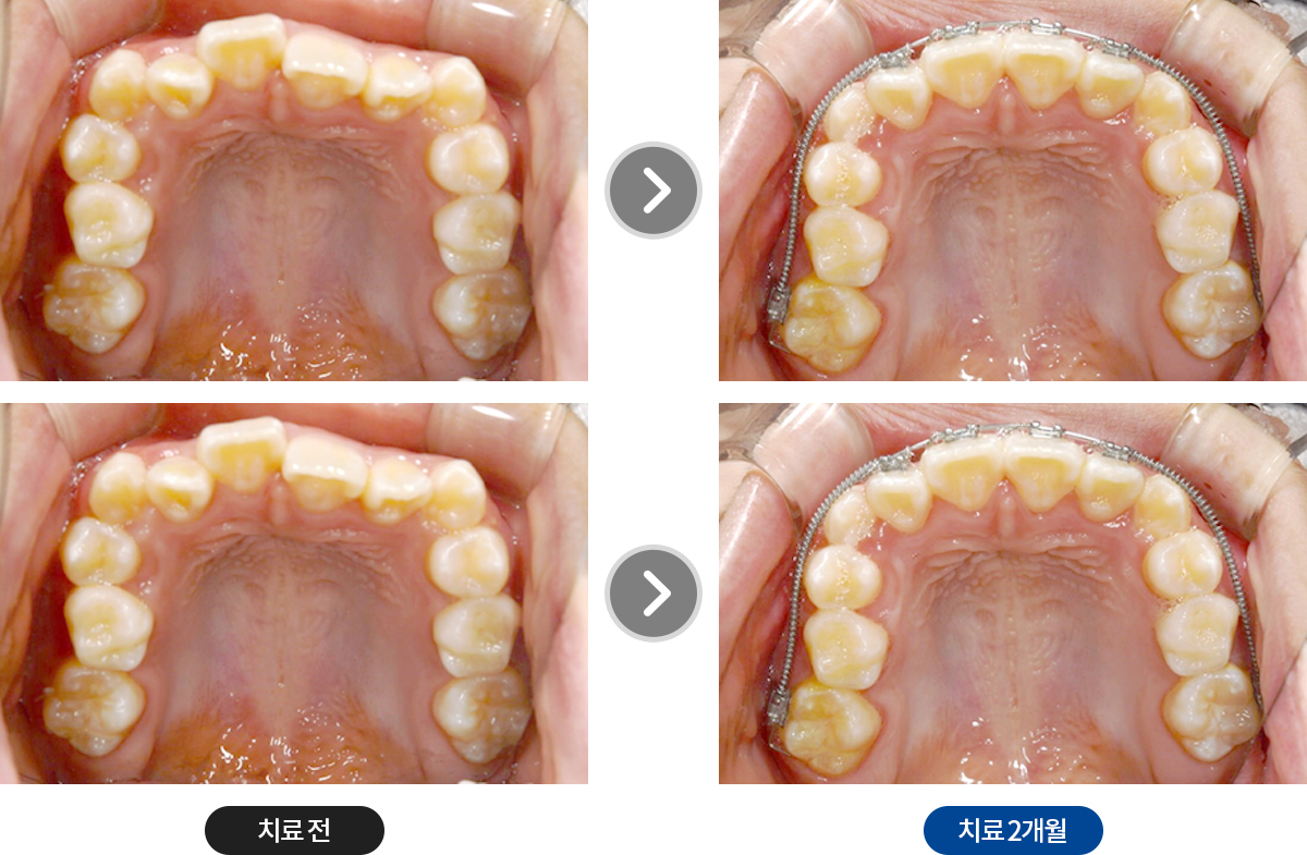 주걱턱교정 - 성장기환자